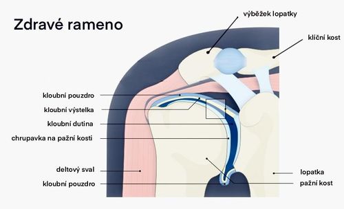 Bolesti ramene - syndrom zmrzlého ramene
